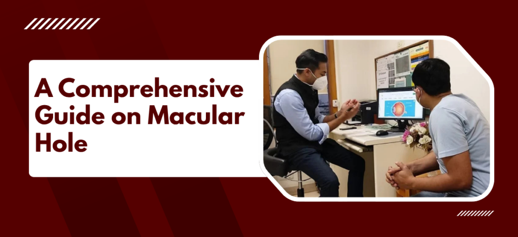 A Comprehensive Guide on Macular Hole At Eye Hospital In Delhi