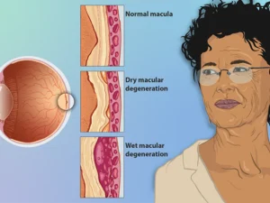 Understanding Age-Related Macular Degeneration (AMD): Causes, Diagnosis, and Treatment