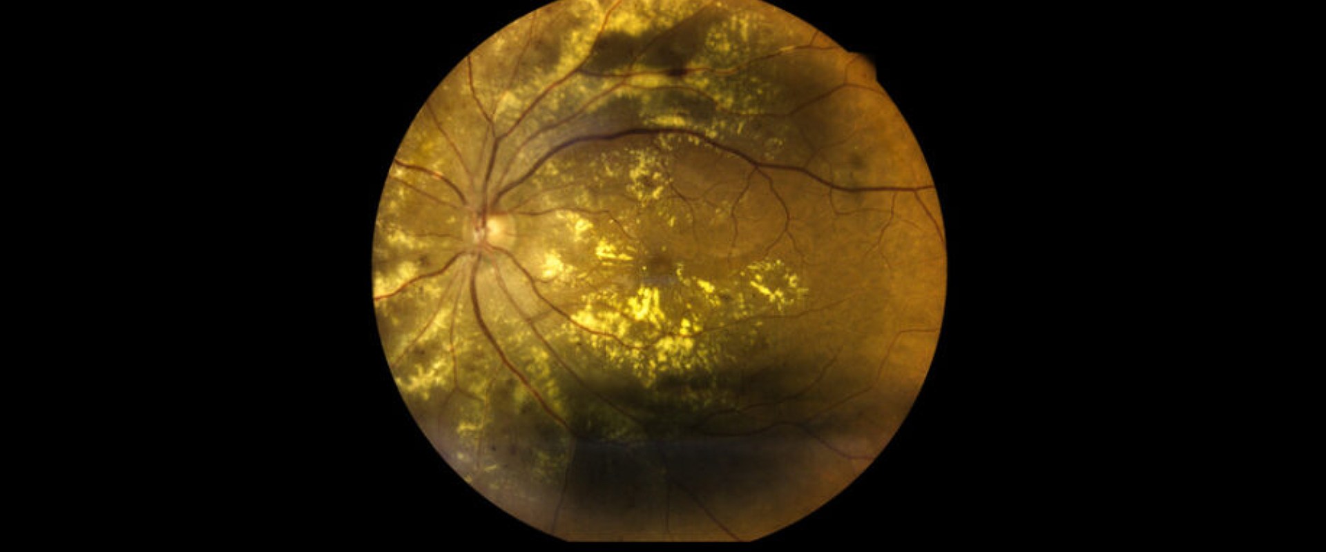 Retinal