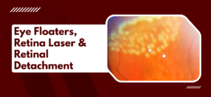 Eye Floaters, Retina Laser & Retinal Detachment