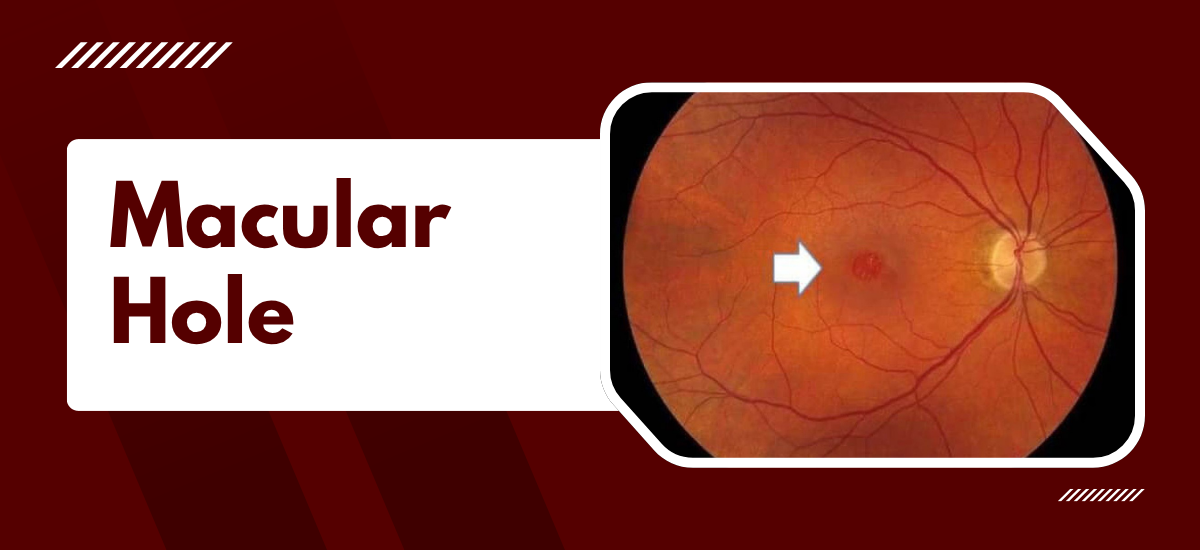 Macular Hole: What Patients Actually Need to Know