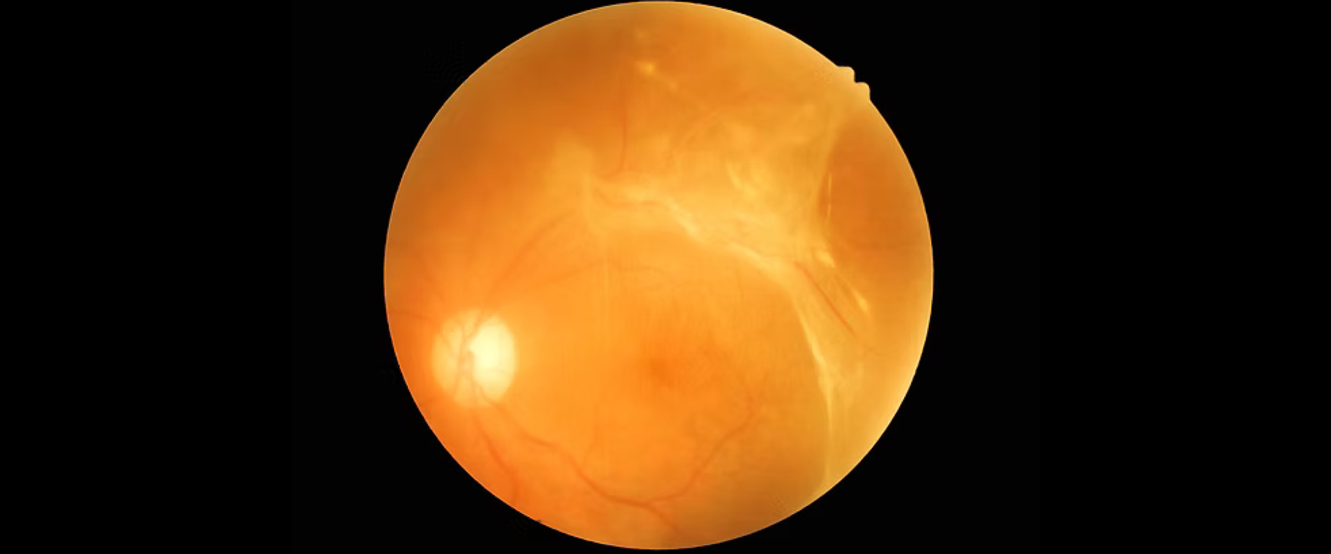 Retinal