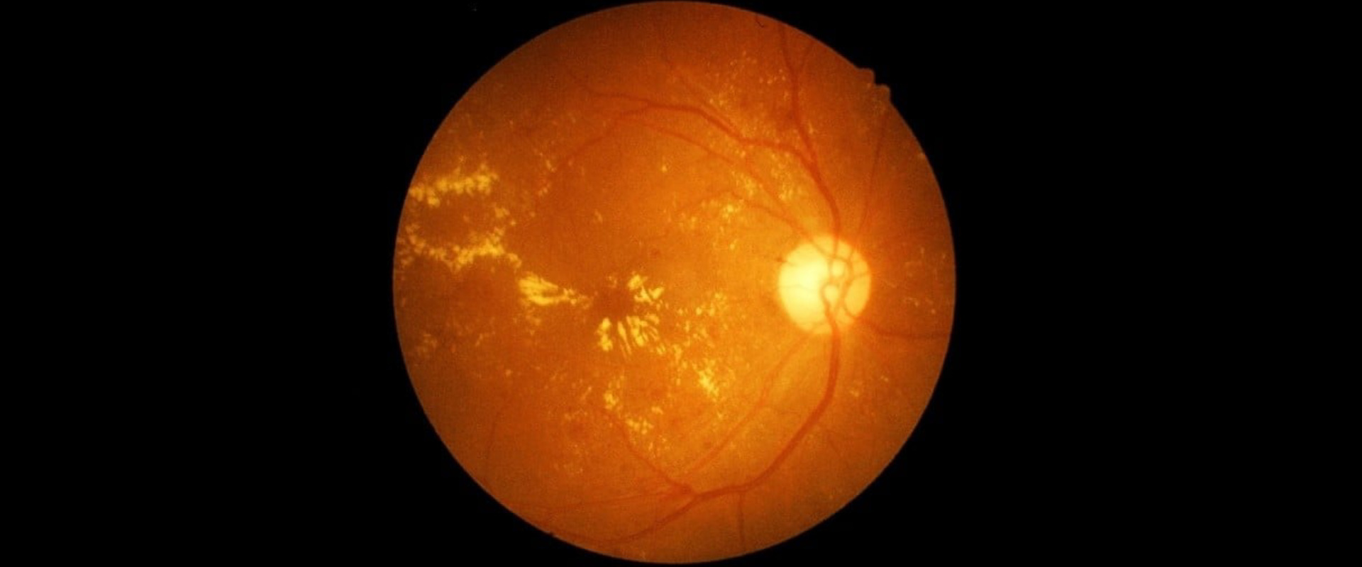 Retinal