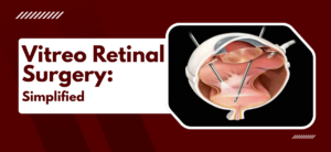 Vitreo Retinal Surgery: Simplified