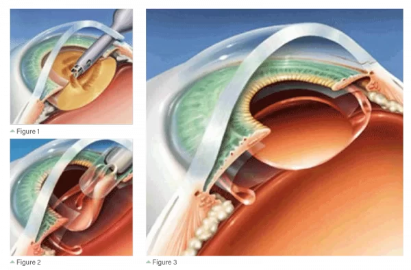 Cataract surgery in Anand Niketan using bladeless technique