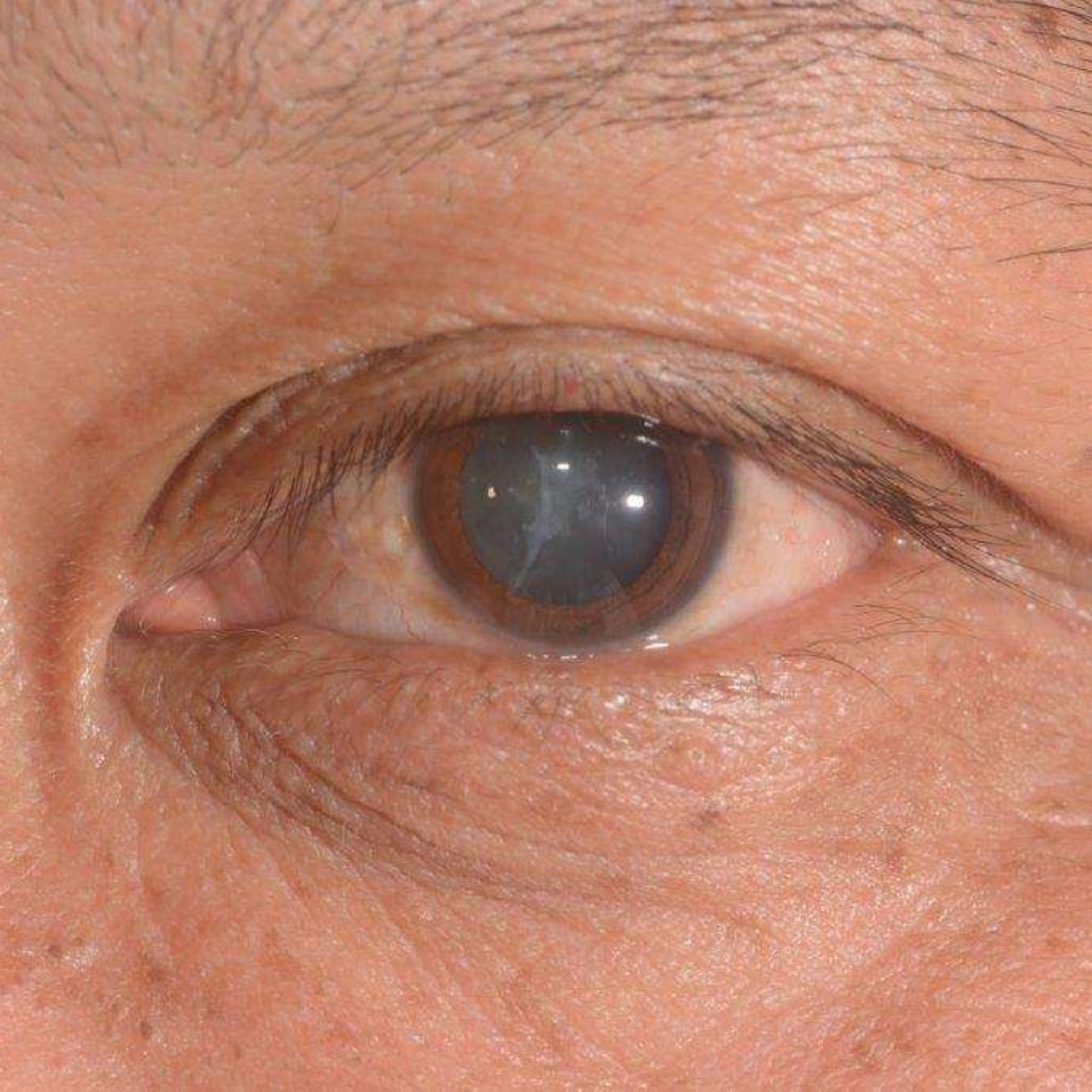 Dr. Mayank Bansal (1) Cataract surgery in Anand Niketan using bladeless technique
