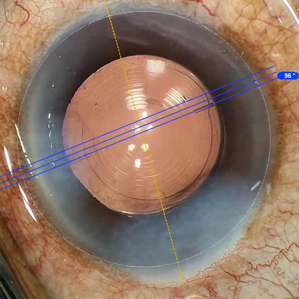 Cataract surgery in Anand Niketan using bladeless technique