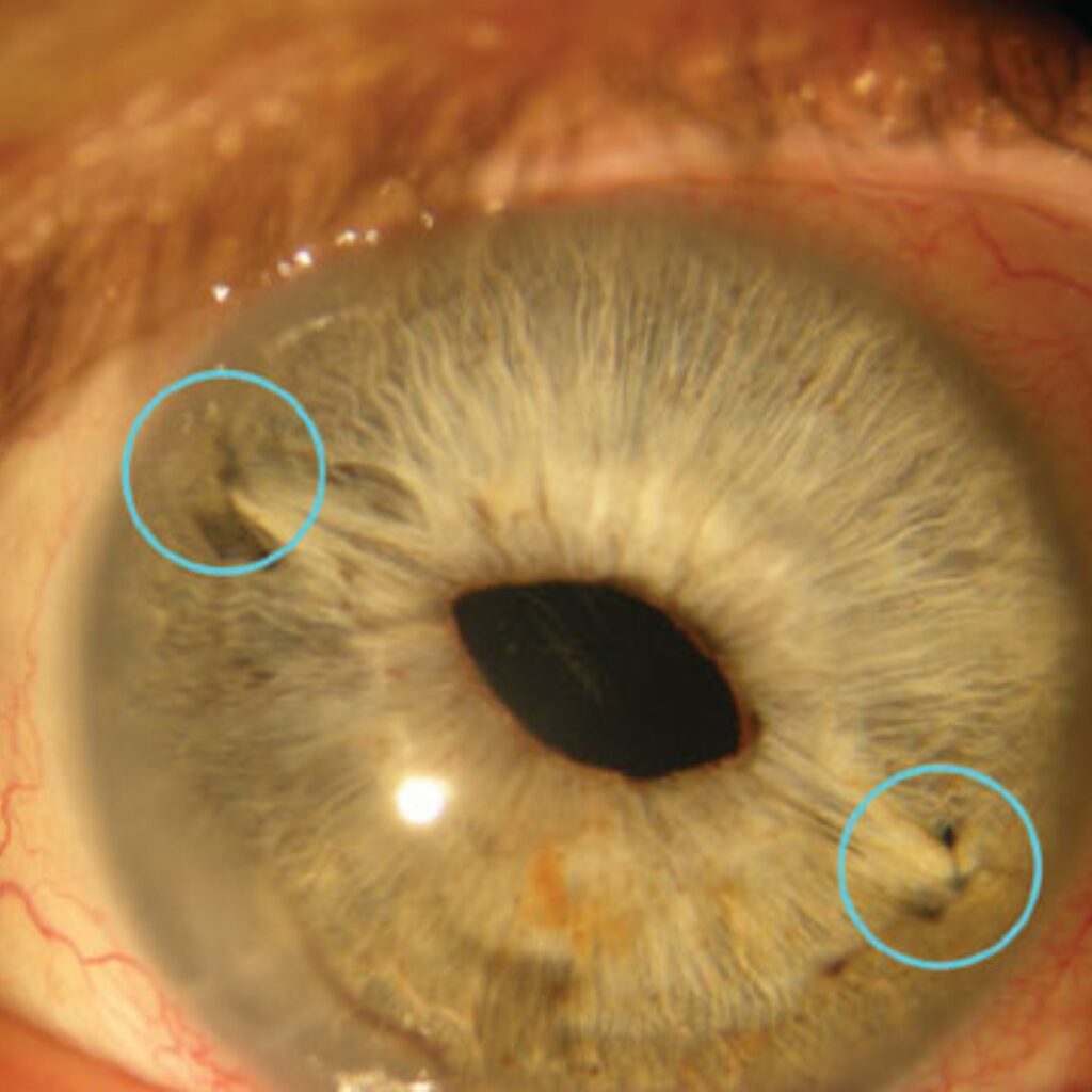 Cataract surgery in Anand Niketan using bladeless technique
