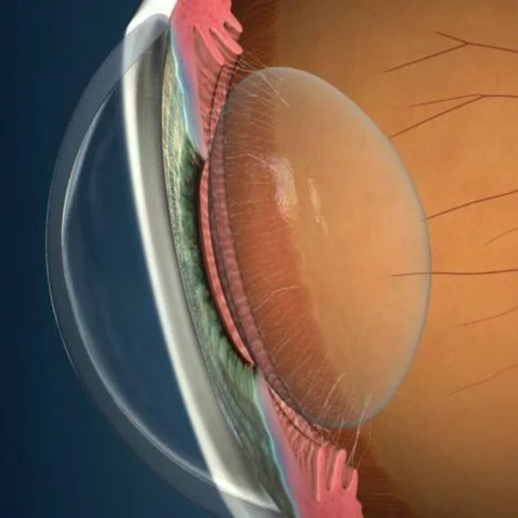 Cataract surgery in Anand Niketan using bladeless technique