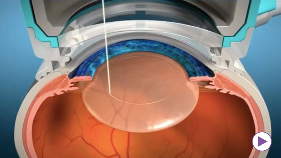 Cataract surgery in Anand Niketan using bladeless technique