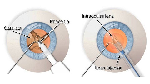 Cataract surgery in Anand Niketan using bladeless technique