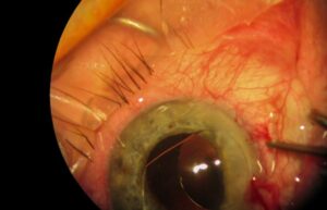 Understanding Different Types of Cataracts