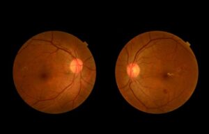 Comprehensive Guide to Retinal Disease Surgery at Claritas Eye & Retina Institute, Delhi