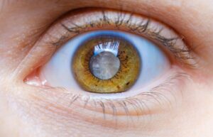 Cataract Surgery in Seniors: Why Delaying Treatment Can Affect Quality of Life