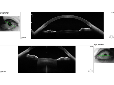 specs removal surgery