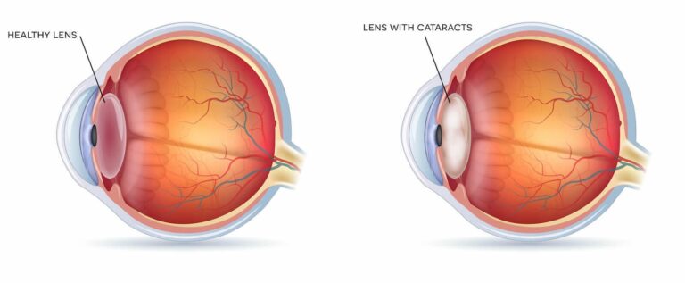 Cataract Surgery