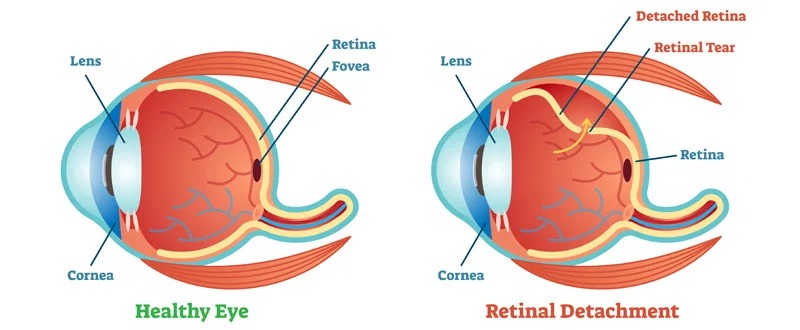 Retina Surgery