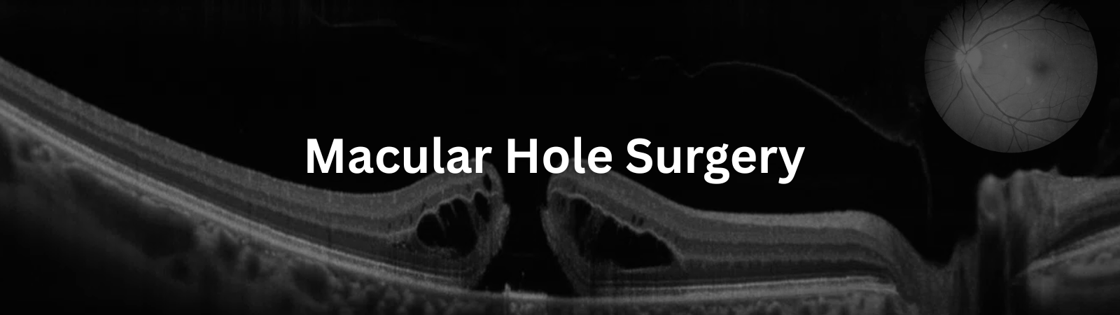 Macular hole surgery in Delhi