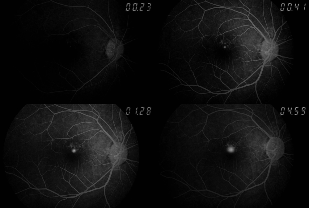 Montage of four grayscale retinal fundus images showing the optic discs and branching retinal vessels, with small bright spots and timer-like numbers in the corners.