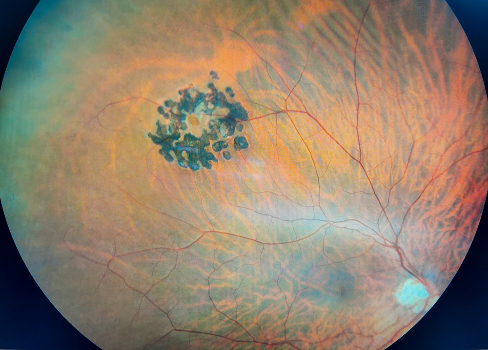 Fundus photograph of the retina showing a cluster of dark irregular spots near the central macula with surrounding orange-pink retinal pigment and visible blood vessels.