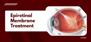 What Is Epiretinal Membrane Treatment?