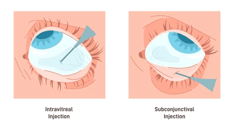 Left: intravitreal injection—needle delivering medication into the vitreous of the eye. Right: subconjunctival injection—needle delivering medication under the conjunctiva.