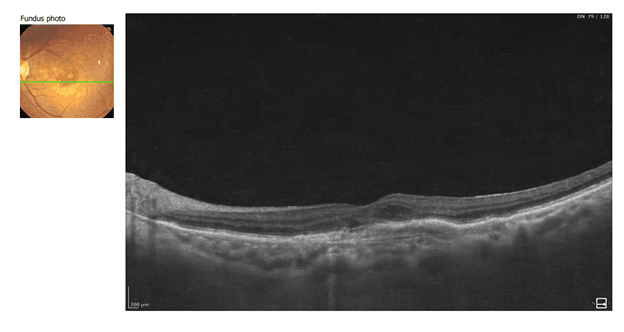 OCT scan of the retina showing a folded neurosensory layer with subretinal fluid; inset fundus photo with a green scan line indicating location