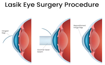 Three-panel LASIK illustration: left shows hinged corneal flap; center shows laser reshaping the cornea; right shows flap repositioned over the cornea.
