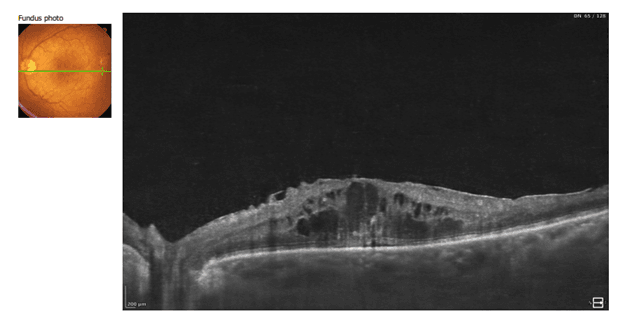 OCT scan of the retina showing irregular retinal contour with subretinal fluid and possible detachment in the macular region.