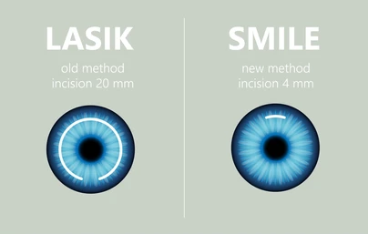 Side-by-side comparison of LASIK methods: left shows old method with a 20 mm incision and a stylized blue iris; right shows new method with a 4 mm incision.