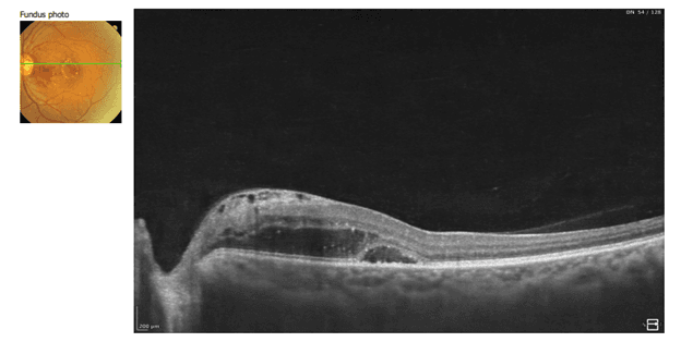 Cross-sectional OCT of the retina showing a raised edge and subretinal fluid with a small retinal detachment; inset fundus photo in the upper-left corner.