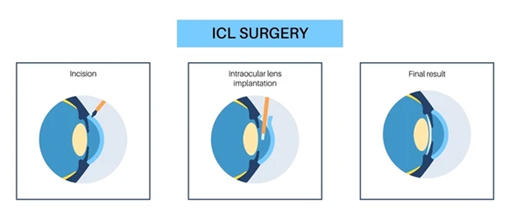 Three-panel diagram of ICL surgery: Incision, intracocular lens implantation, and final result.