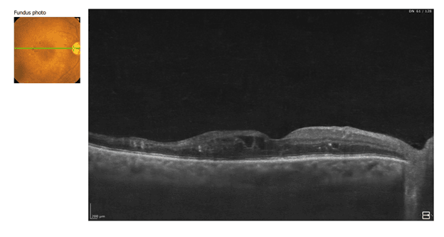 Composite ophthalmology image: left fundus photo, right horizontal OCT cross-section showing subretinal fluid and elevated retina at the macula.