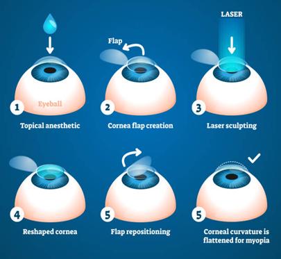 Six-step eye procedure: topical anesthetic, corneal flap creation, laser sculpting, flap repositioning, and flattened corneal curvature for myopia.
