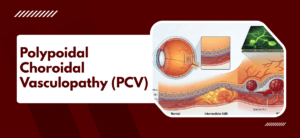 What Is Polypoidal Choroidal Vasculopathy (PCV)?
