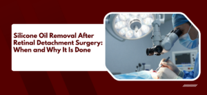 Silicone Oil Removal After Retinal Detachment Surgery: When and Why It Is Done