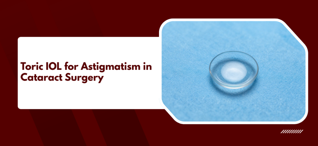 Toric IOLs correct astigmatism during cataract surgery, reducing dependence on glasses for distance.