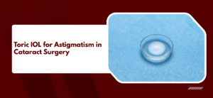 Toric IOL for Astigmatism After Cataract Surgery: Candidacy, Cost, and Vision Outcomes