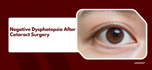 Negative Dysphotopsia After Cataract Surgery: Causes, Patient Experience, and Solutions